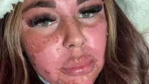 Die britische Influencerin Natalia Armstrong erlitt schwere Hautverbrennungen, nachdem sie sich falsch herum auf eine Sonnenbank gelegt hatte.