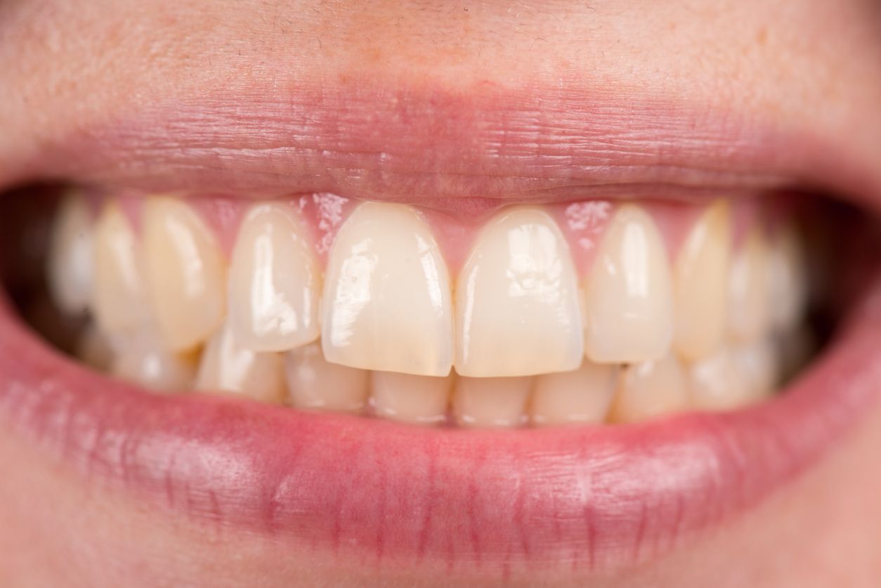 Für eine komplette Mund-/Zahnhygiene wird die Verwendung von Zahnseide empfohlen.