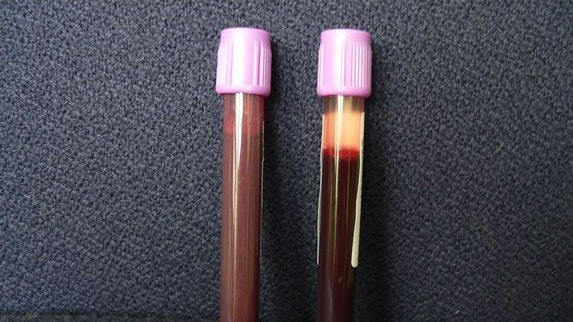 Die Blutprobe des Mannes kurz nach Eintreffen im Spital (li.) und bei der Entlassung (re.). Die milchige Verfärbung fällt auf.