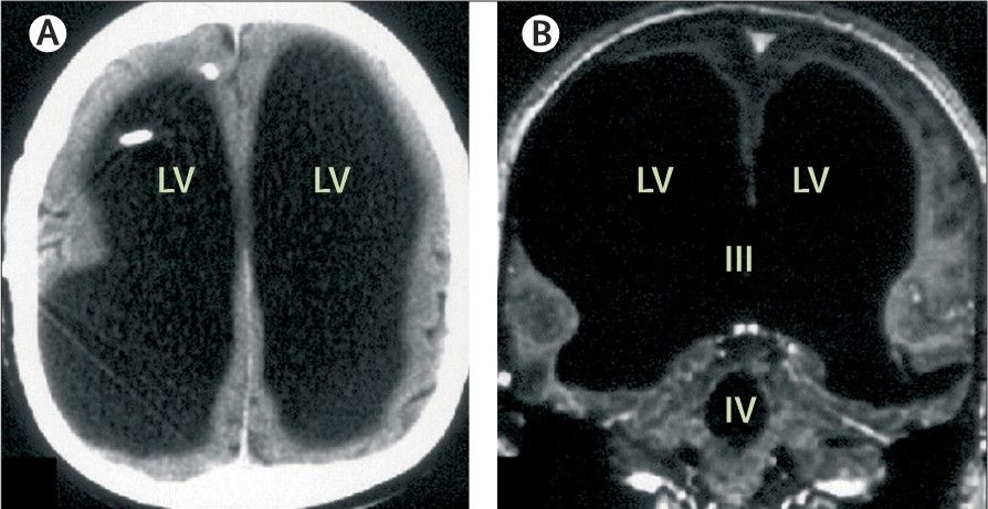 Die Scans des Mannes zeigen (Bild), dass sein Gehirn an den Rand des Schädels gedrängt worden war. Der schwarze Raum in der Mitte war mit Flüssigkeit gefüllt.