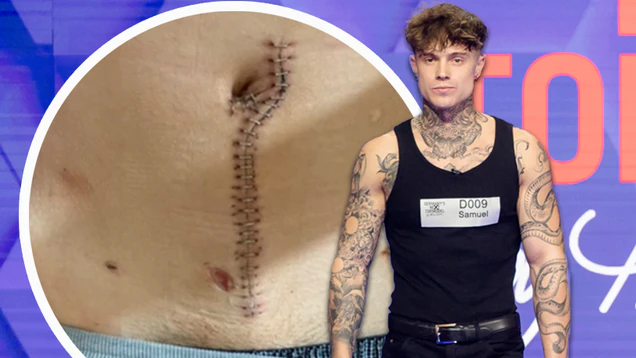 Samuel war bei "GNTM" dabei - auf Instagram zeigt er ganz offen seine Wunde nach dem Messerangriff.