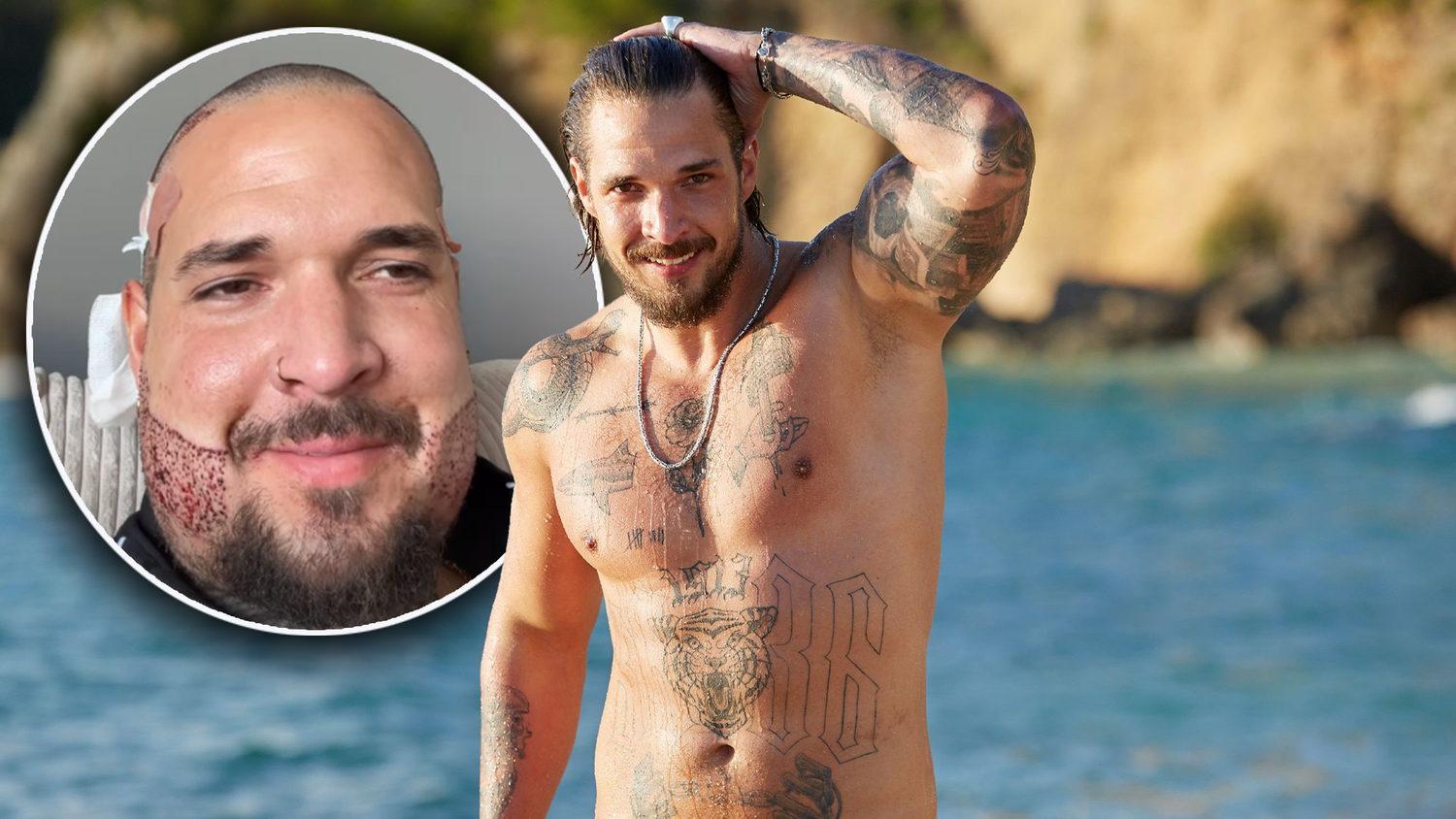 Bachelorette-Kandidat Zico Banach unterzog sich einer Haar- und Barttransplantation. Die Bilder nach der OP schockieren.