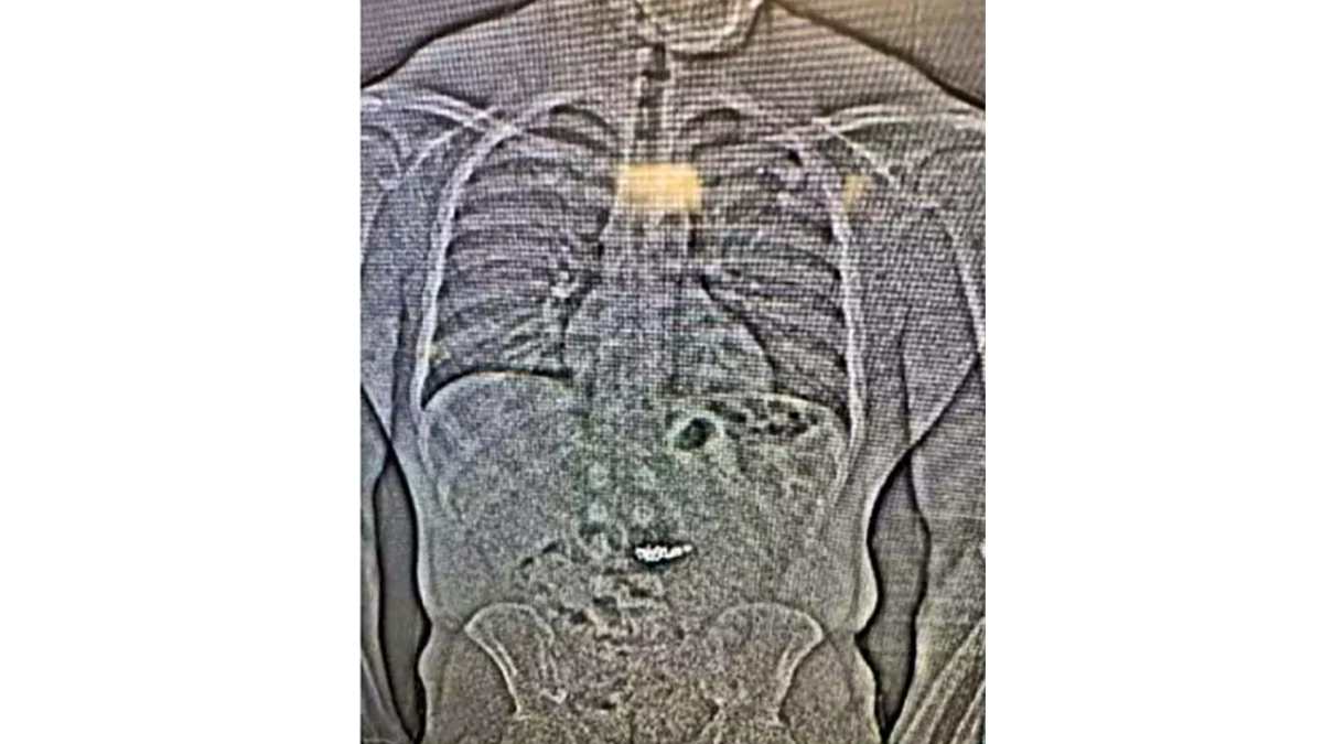 Die Polizei spürt den Dieb auf – doch bevor sie die Beute sicherstellen kann, verschluckt der Verdächtige die Ohrringe