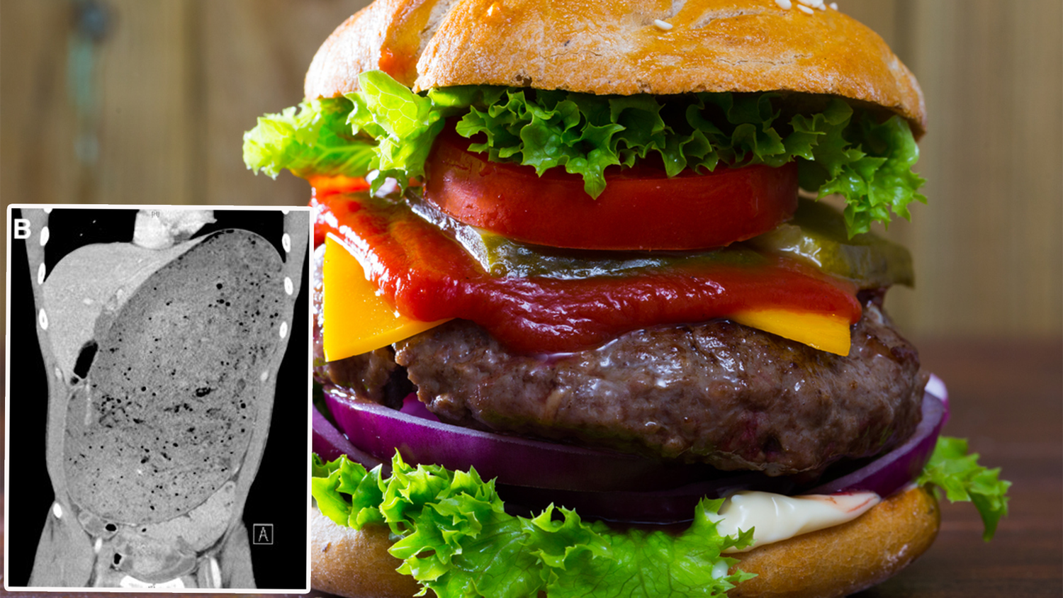 Der CT-Scan (kl. Bild) zeigt, wie sehr der Magen des Mannes überdehnt war.