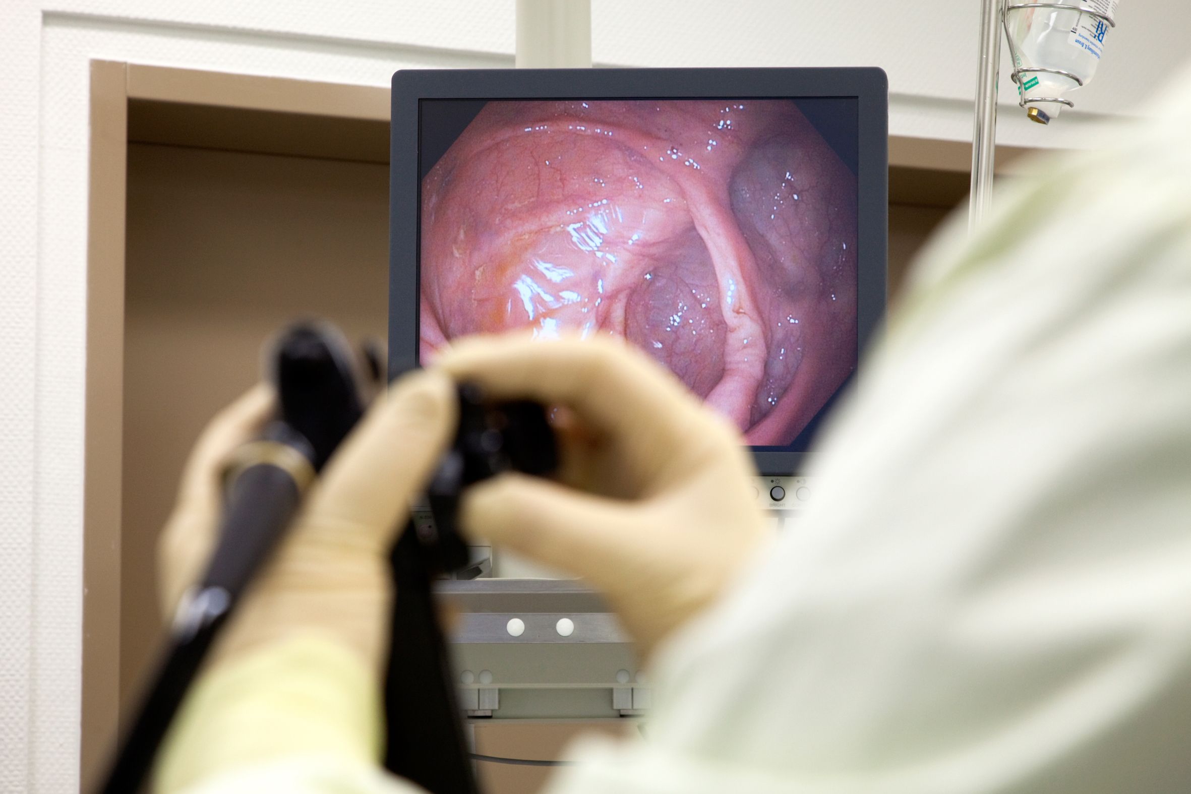 Spätestens ab dem vollendeten 50. Lebensjahr kann eine Vorsorgekoloskopie kostenlos durchgeführt werden, mit Überweisung eines Arztes auch früher.
