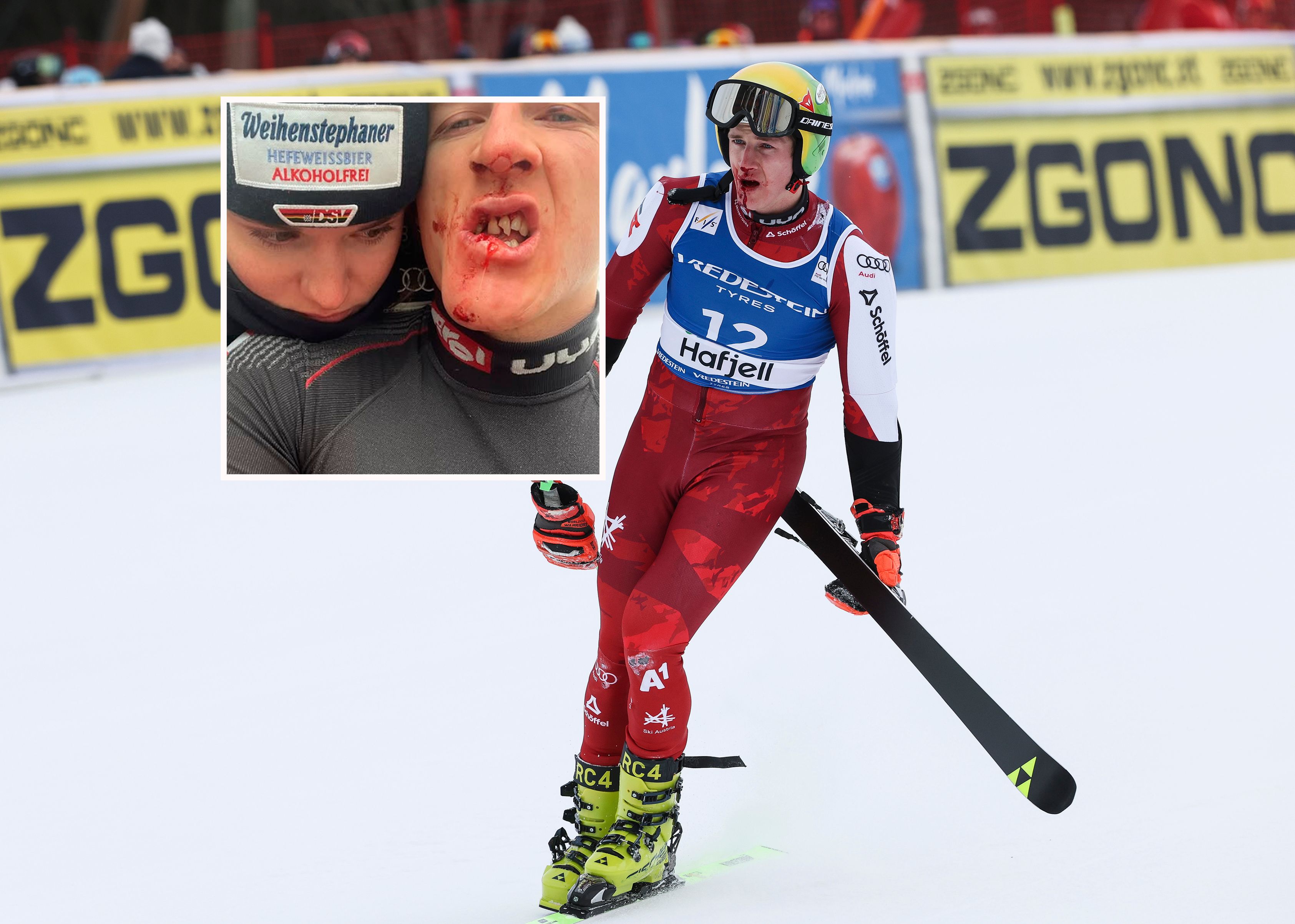 Fabiana Dorigo (l.) teilte die Haaser-Verletzung auf Instagram.