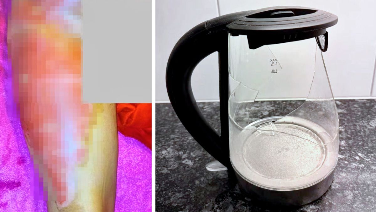 Nach Wasserkocher-Unfall: Angela ist schwer verletzt und musste operiert werden