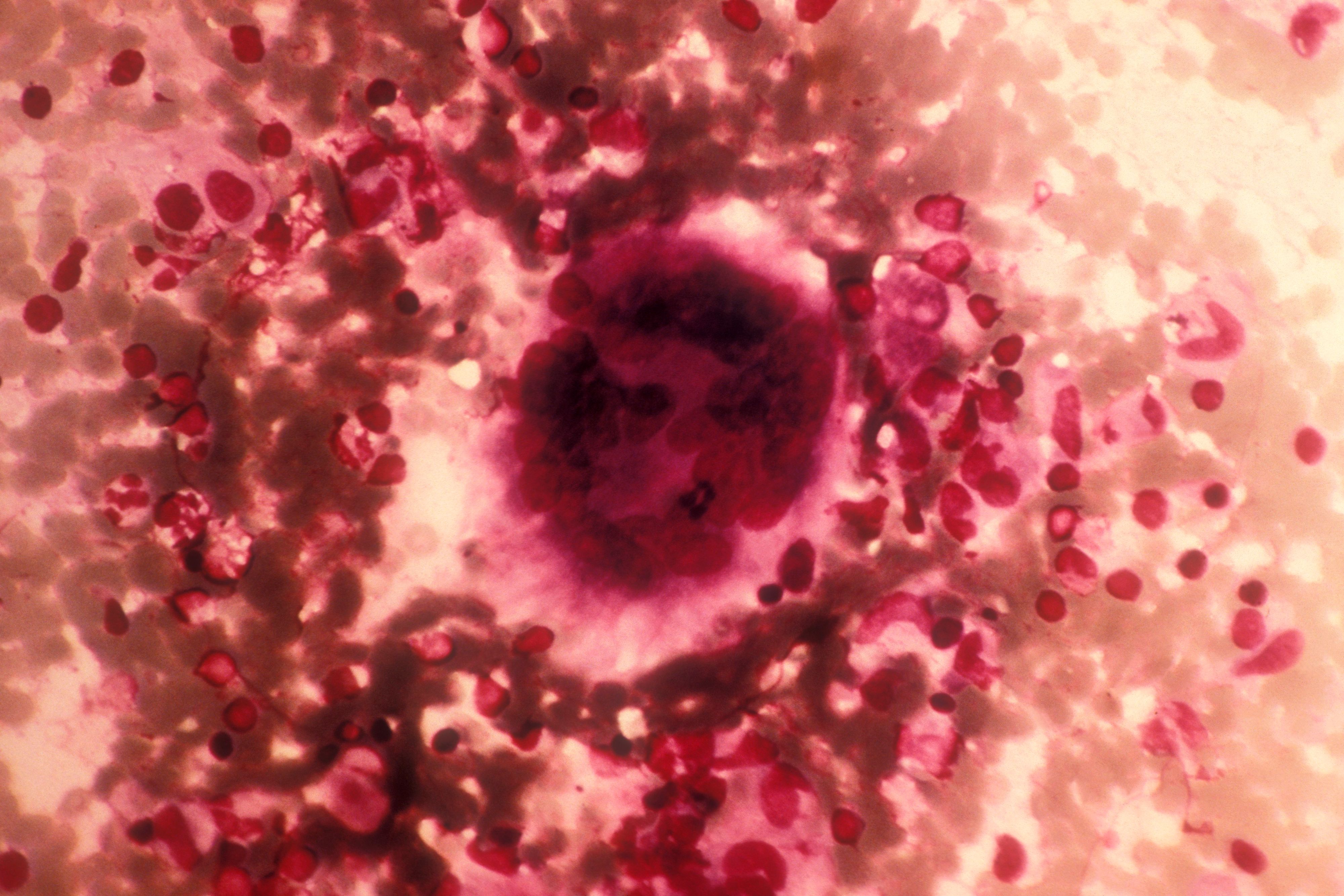 Eine Tuberkulose-Infektion unter der Lichtmikroskopie.