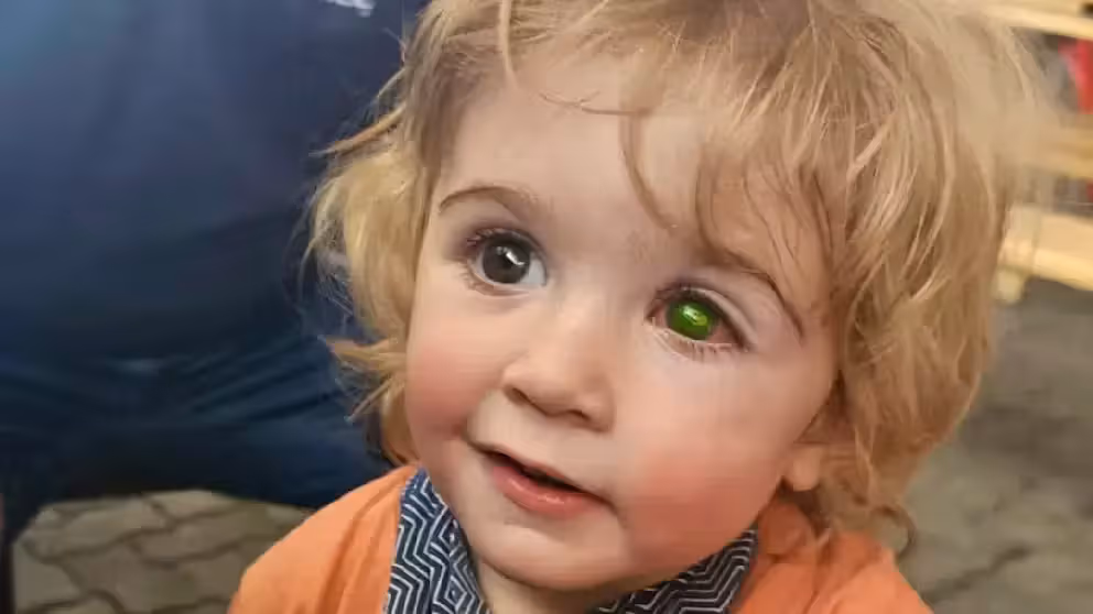 Eine Herpes-Infektion hat das linke Auge von Juwan (2) schwer beschädigt.