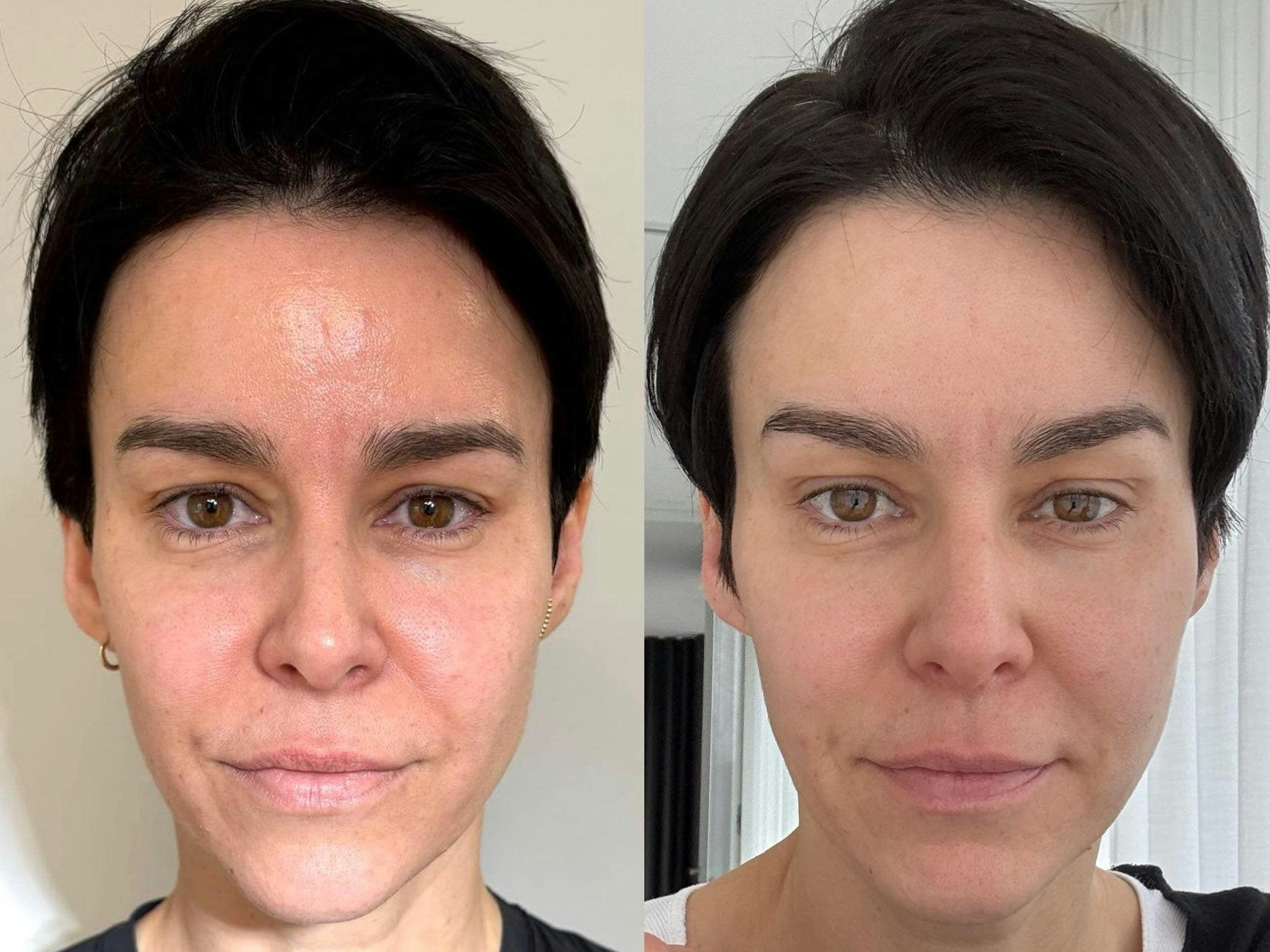 Kerstin Lechner zeigt sich vor und nach der Behandlung