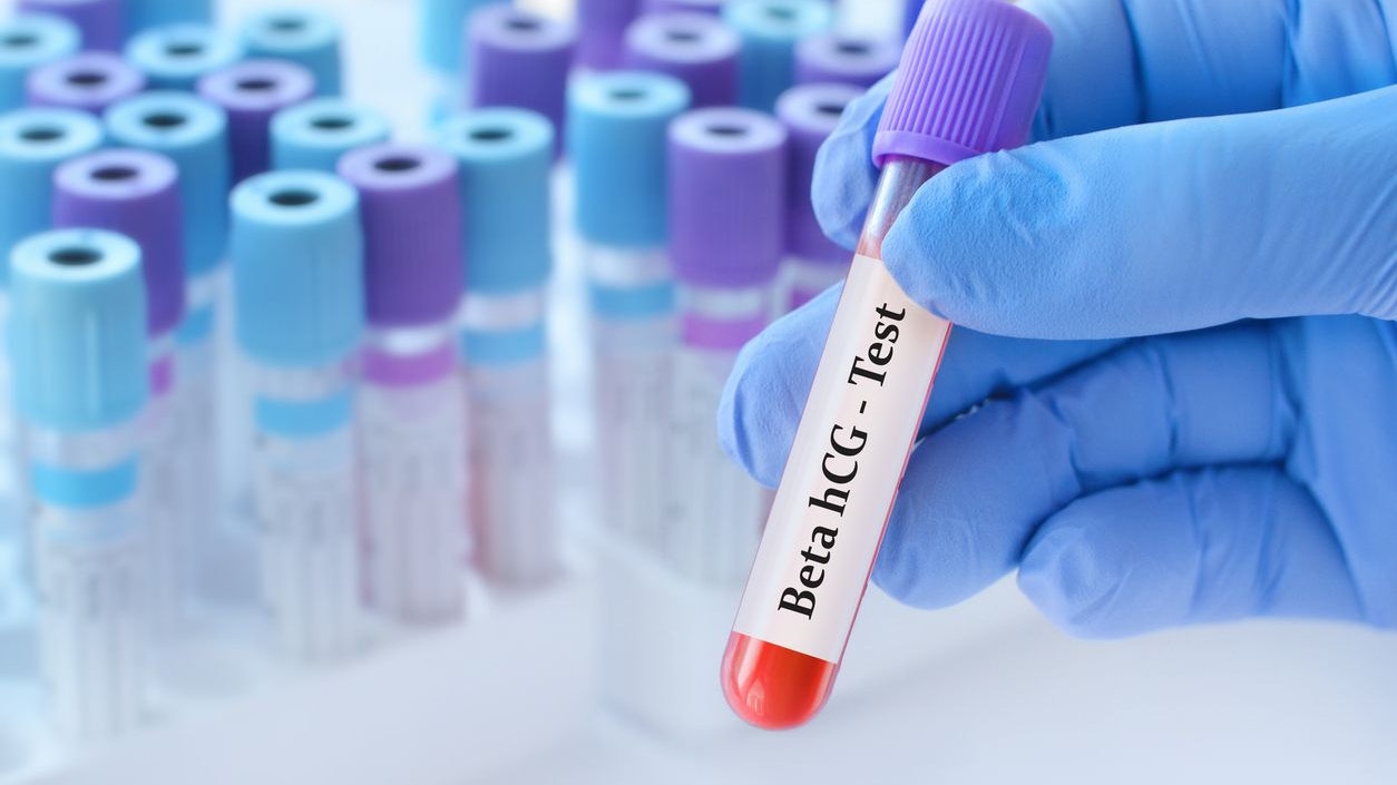 Doctor holding a test blood sample tube with Beta hCG test on the background of medical test tubes with analyzes.