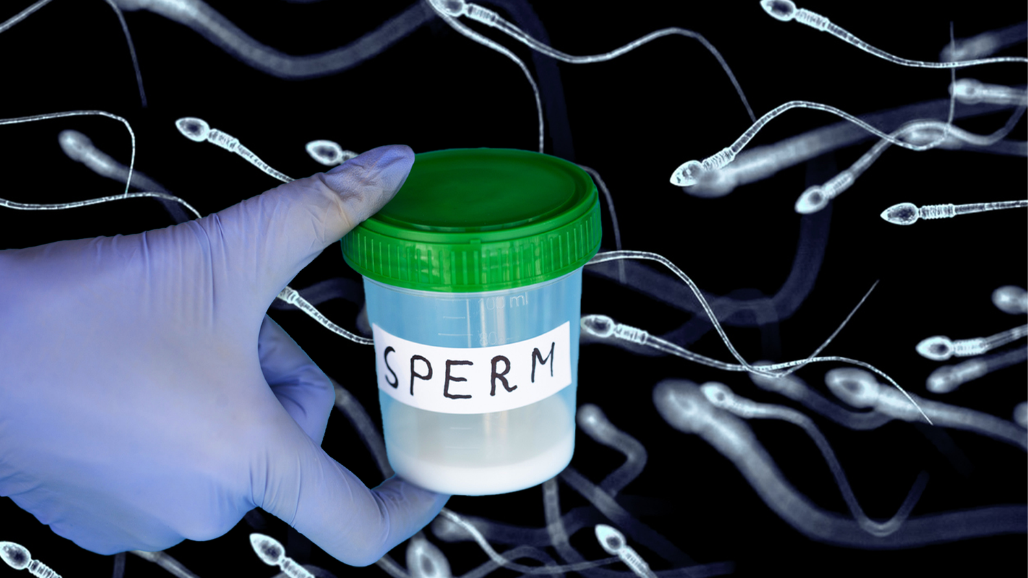 Erkrankungen und Behandlungen wie eine Chemotherapie können die spermienbildenden Stammzellen schädigen oder ihre Entwicklung zu Spermien blockieren und so zu Unfruchtbarkeit führen.