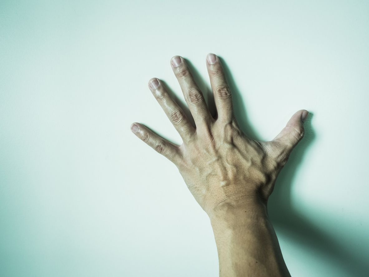 Das Alien-Hand-Syndrom ist eine seltene Erkrankung.