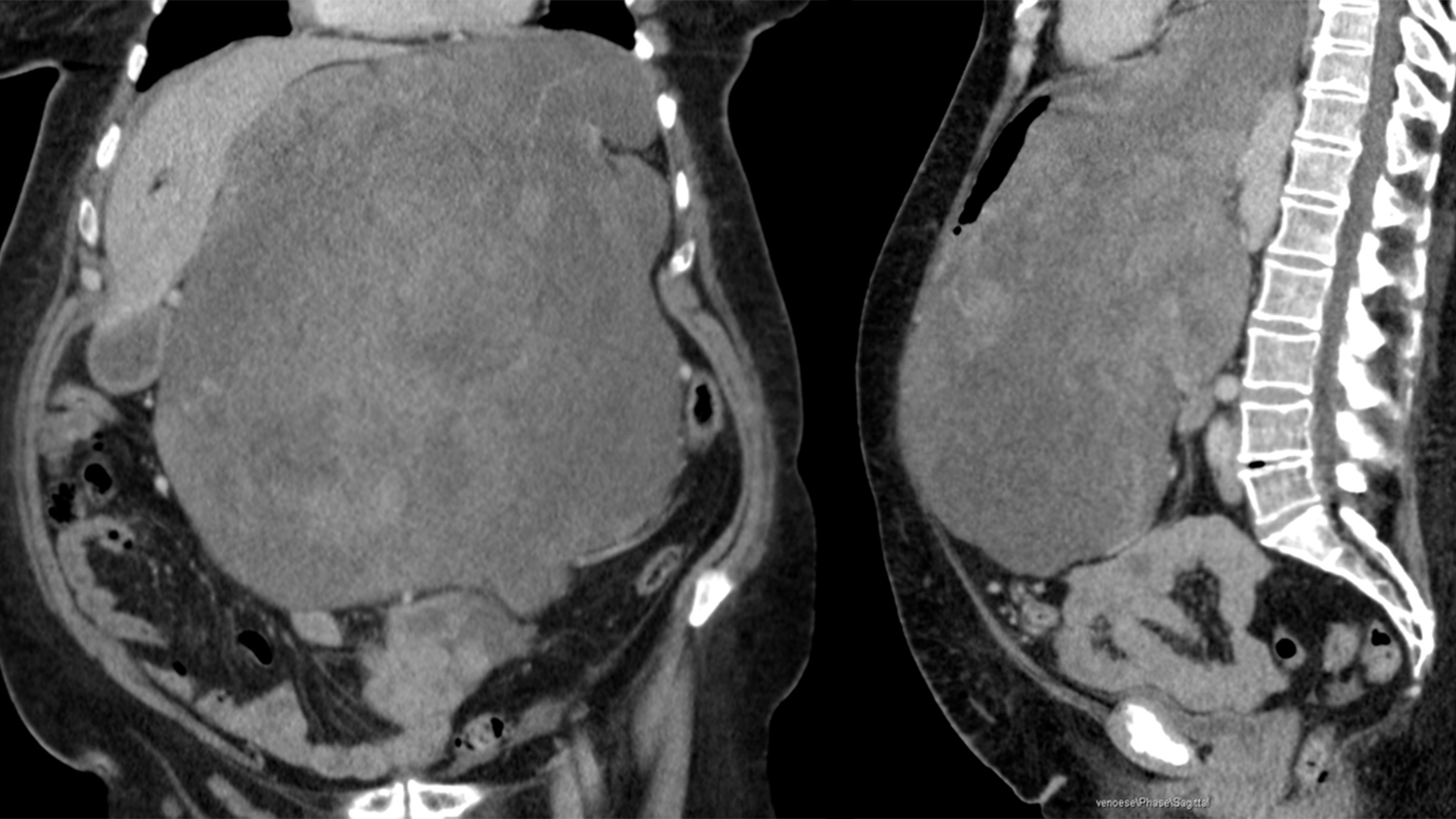 Die CT-Bilder der Patientin zeigen das Ausmaß des Tumors.
