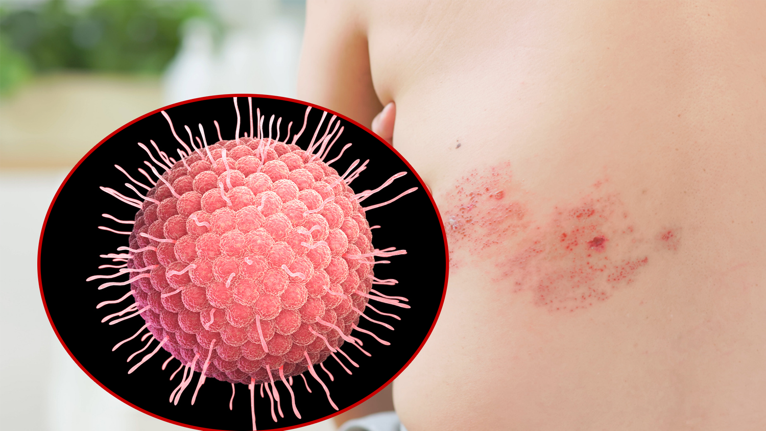 Gürtelrose wird durch das Varizella-Zoster-Virus (Bild) verursacht. Die Folge sind schmerzhafte Bläschen am Körper oder Gesicht.