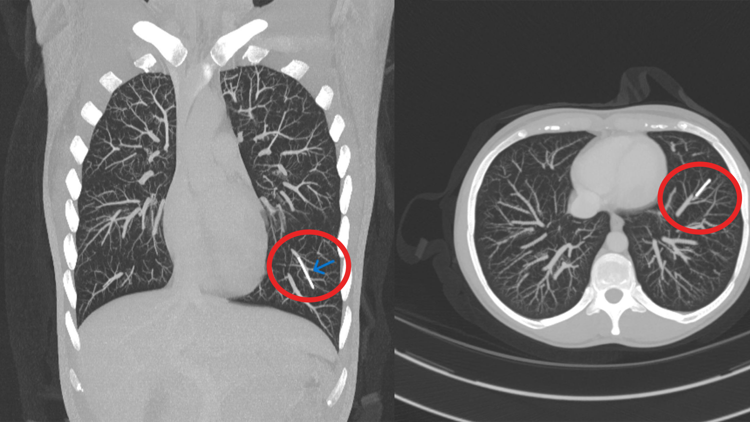 Die CT-Bilder der jungen Frau zeigen das Implantat in der Lunge.