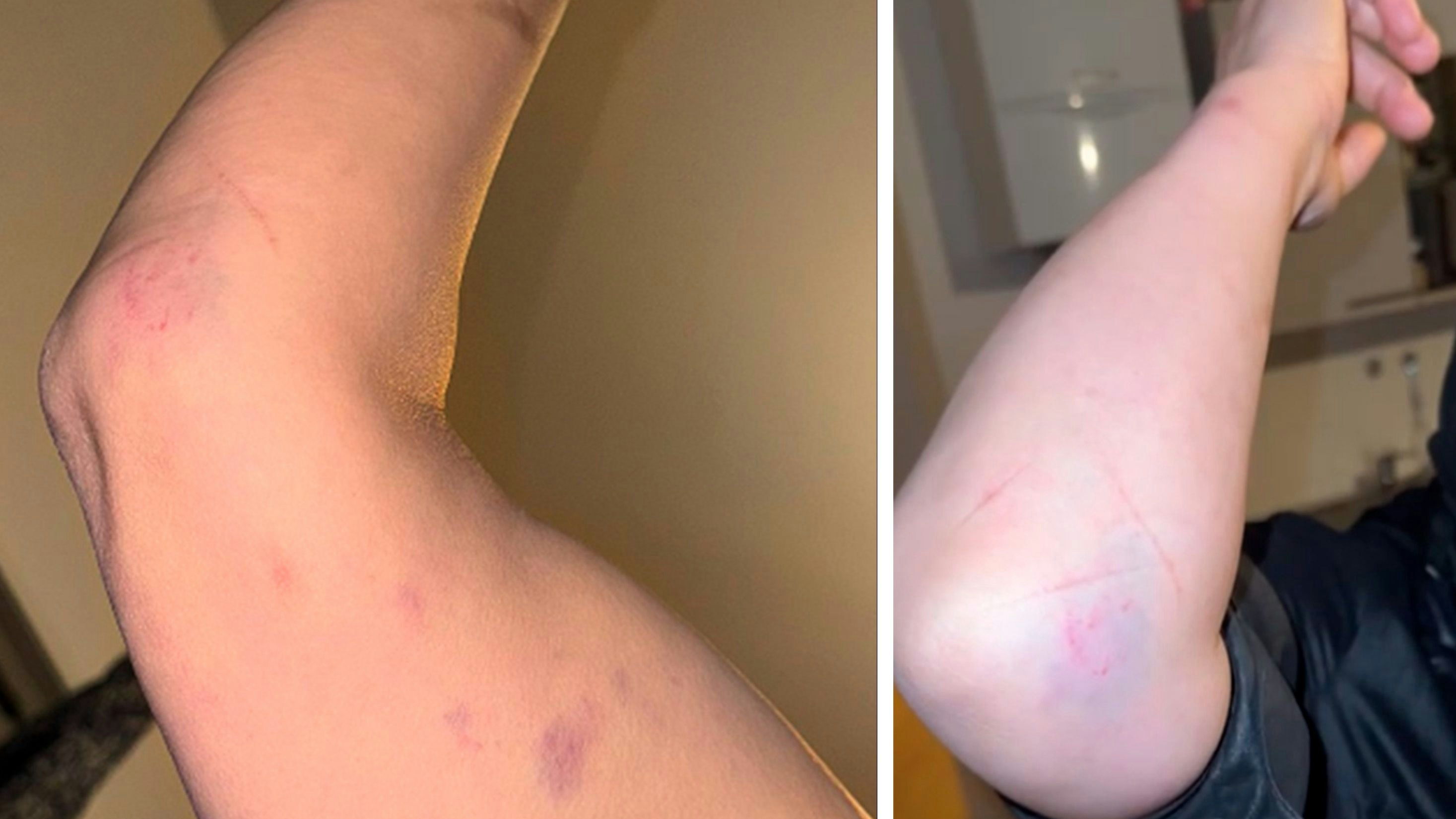 Dokumentierte Verletzungen der Frau, gegen die wegen versuchten Widerstands gegen die Staatsgewalt ermittelt wird.