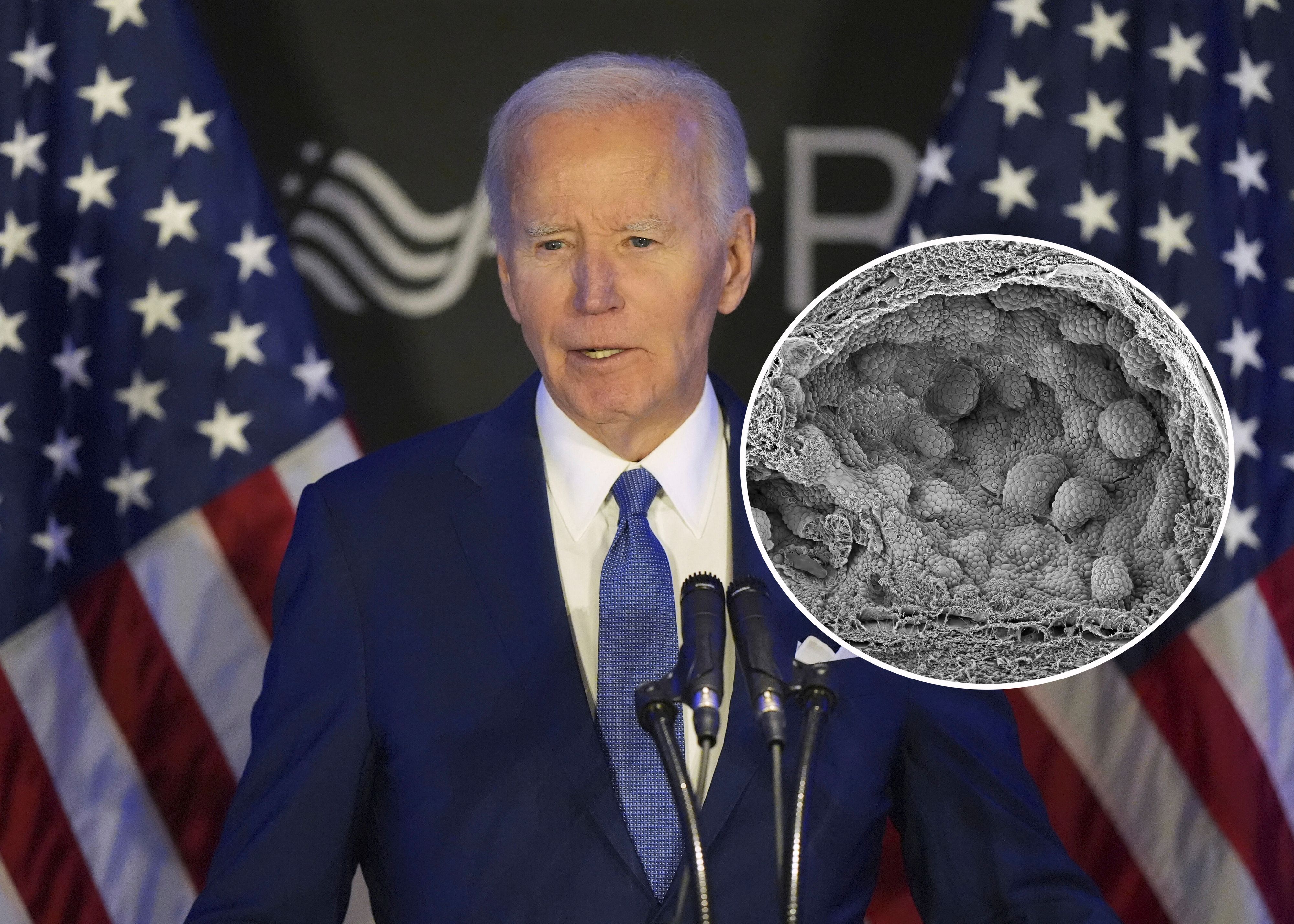 Joe Bidens aggressives Prostatakarzinom ist bereits weit fortgeschritten und hat in die Knochen gestreut.
