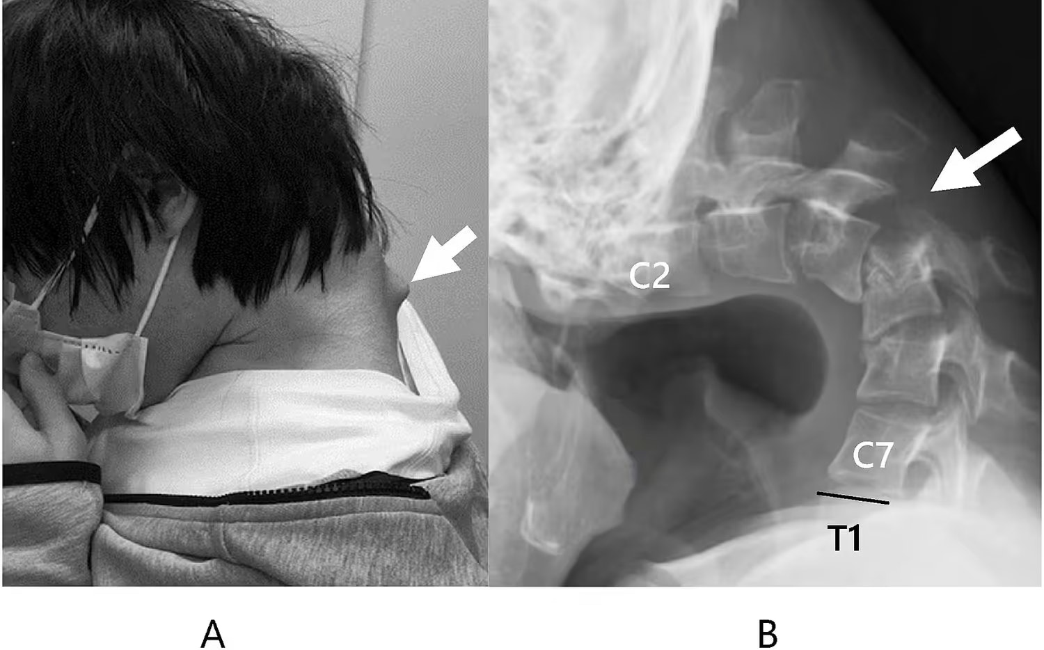 Ein 25-jähriger Japaner entwickelte das Dropped-Head-Syndrom, nachdem er jahrelang in gebeugter Haltung auf sein Handy schaute, wodurch seine Nackenmuskulatur geschwächt und die Halswirbelsäule geschädigt wurde.