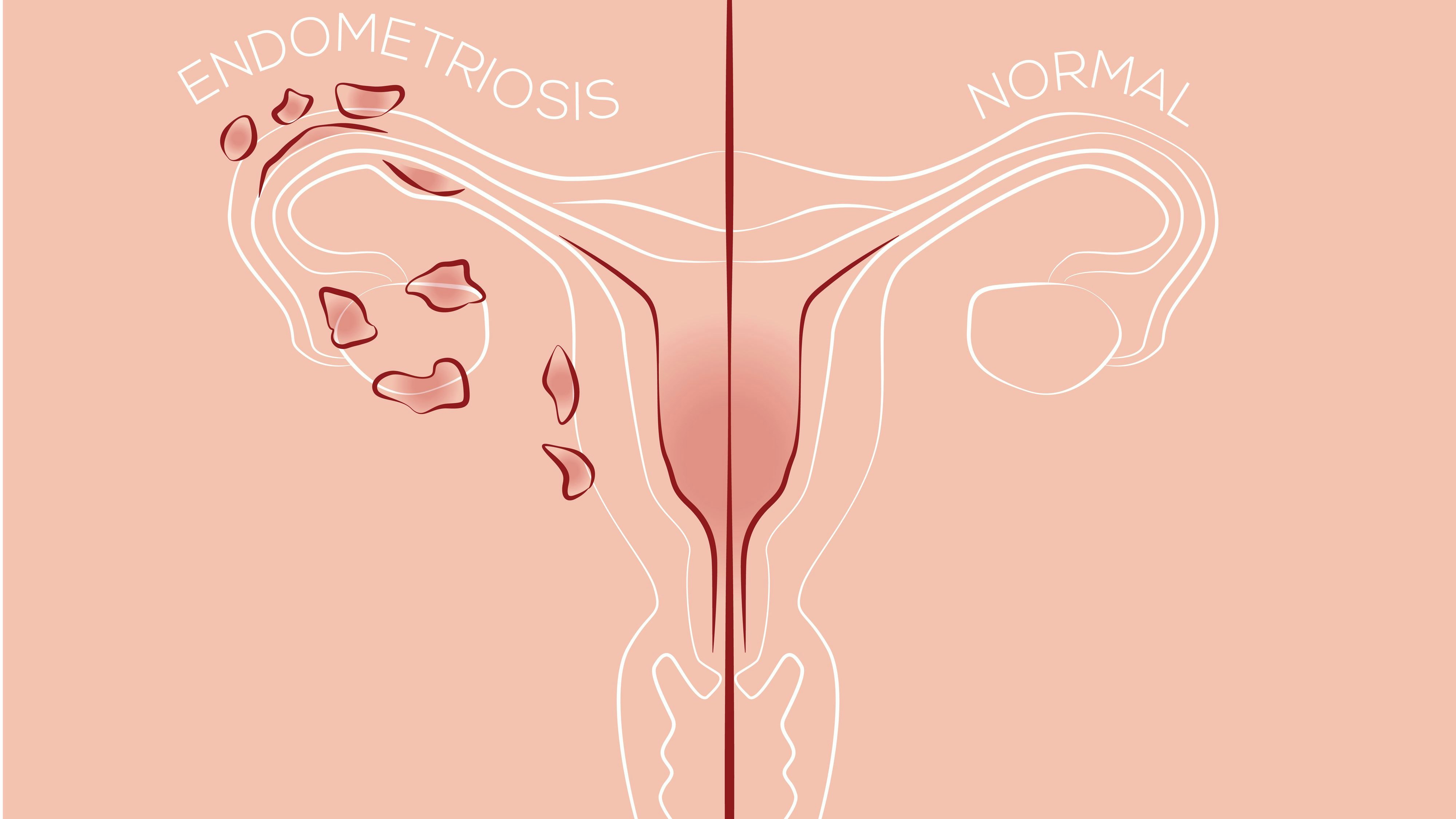 Endometriose im Vergleich zu einem gesunden Eierstock, Eileiter, Uterus.