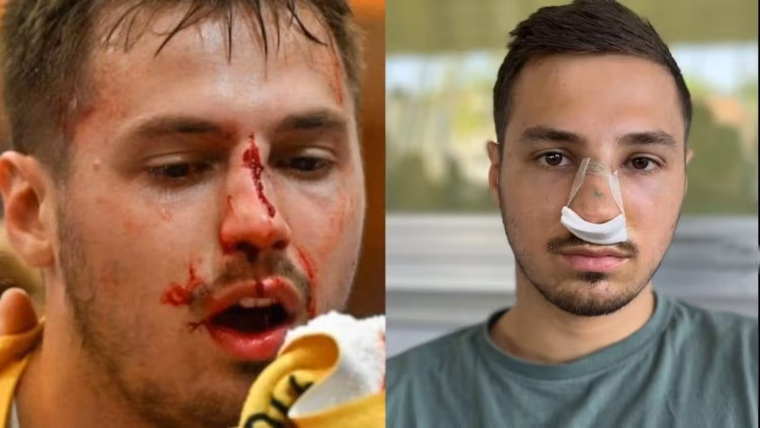 Markus Mahr mit der frischen Wunde auf dem Platz,&nbsp; und nach der Not-OP in Feldkirch.