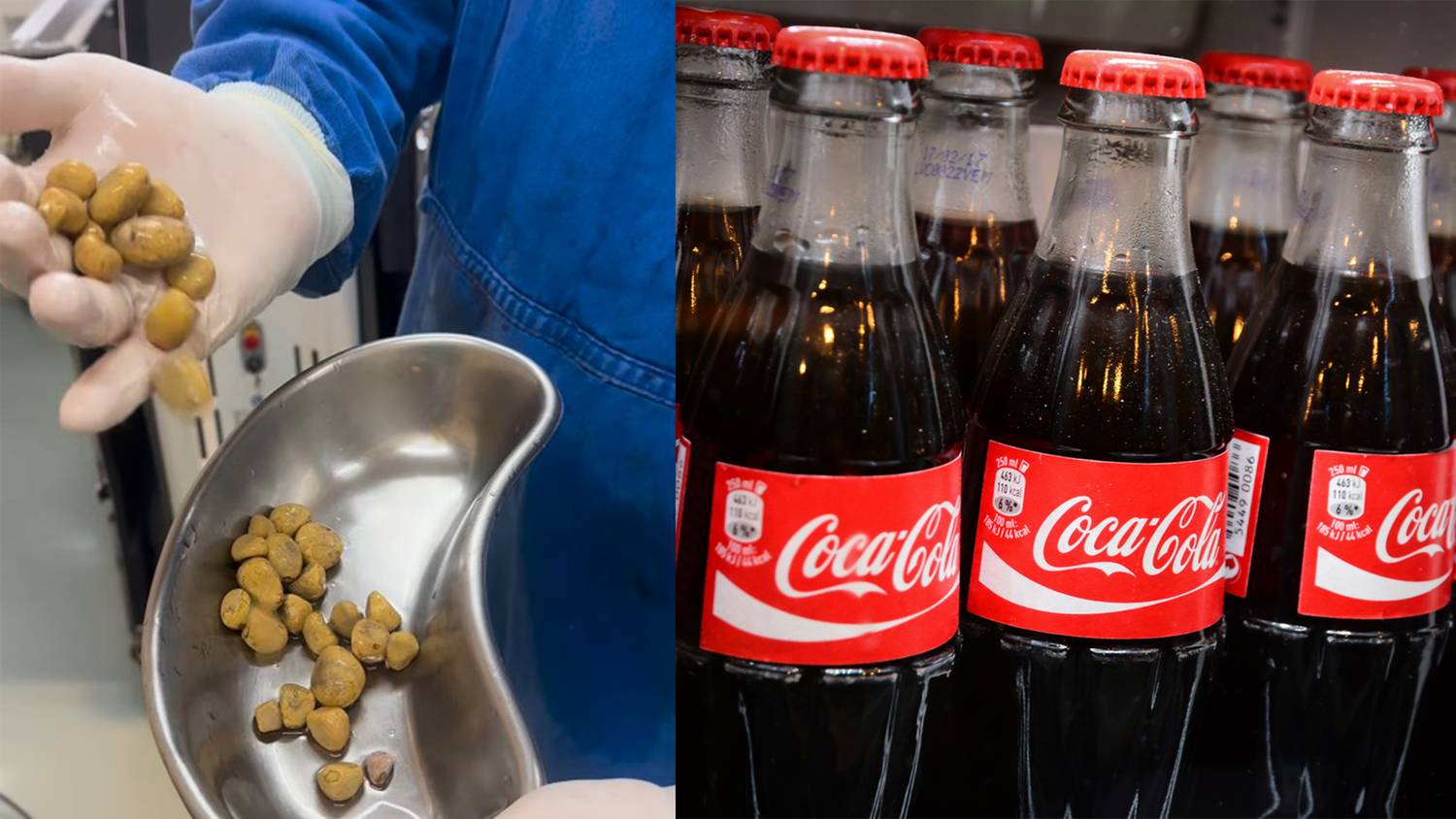 Heute.at - 3 Liter Cola am Tag – Mann hat Nierensteine wie Würfel