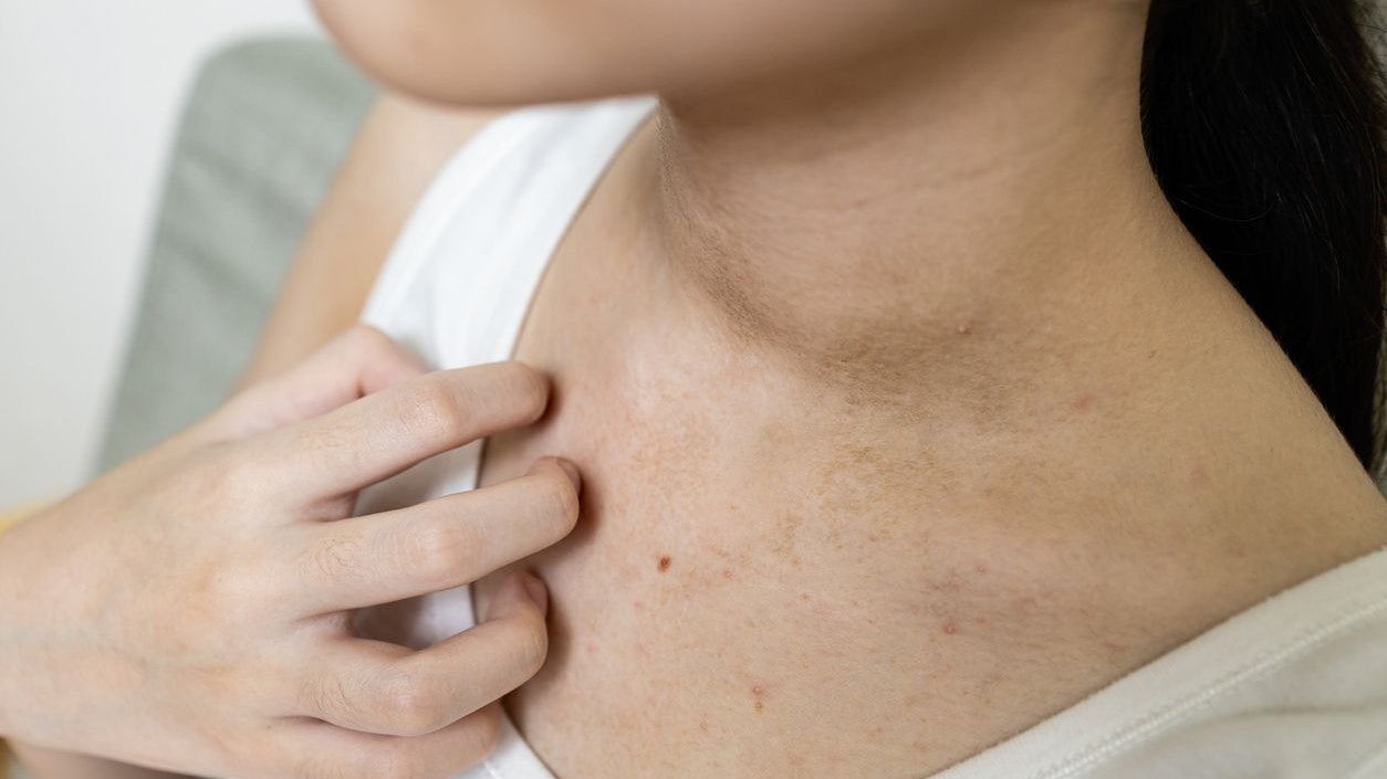 Hand of girl scratching skin,red rash from hot weather,sweat allergy,asian woman with itchy skin,itch rash on her chest and neck,sensitive skin,concept of dermatitis,health care,skin disease problems