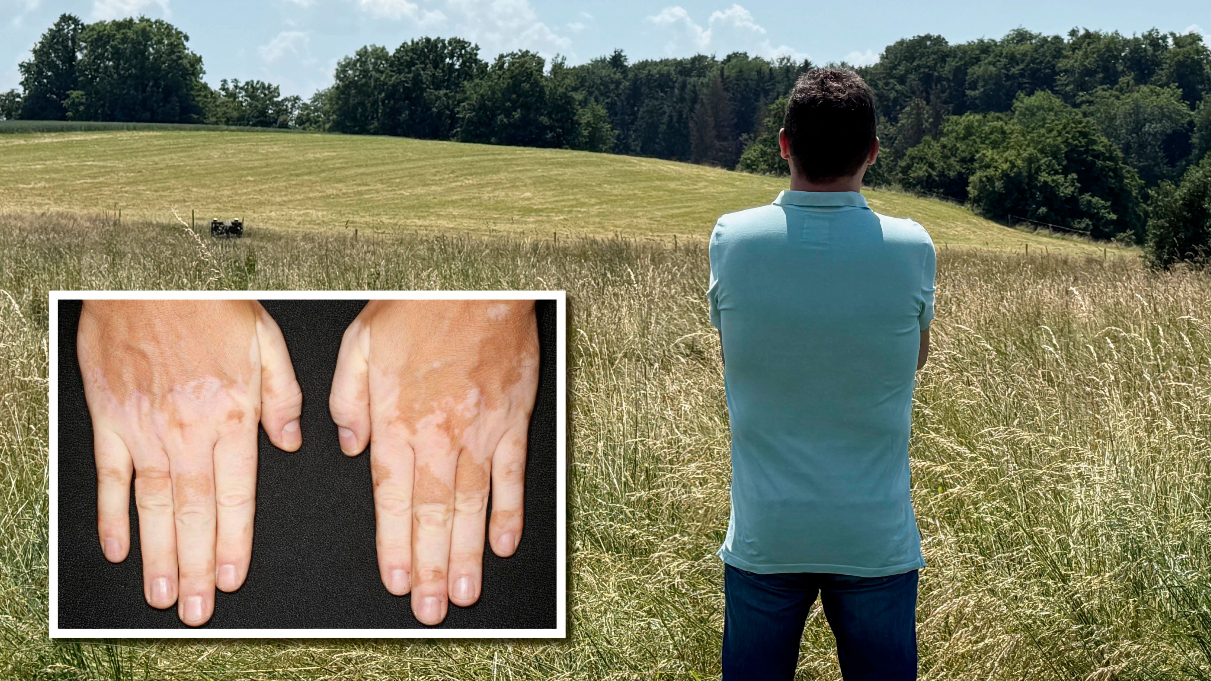 Der Oberösterreich erkrankte vor rund zehn Jahren an Vitiligo.
