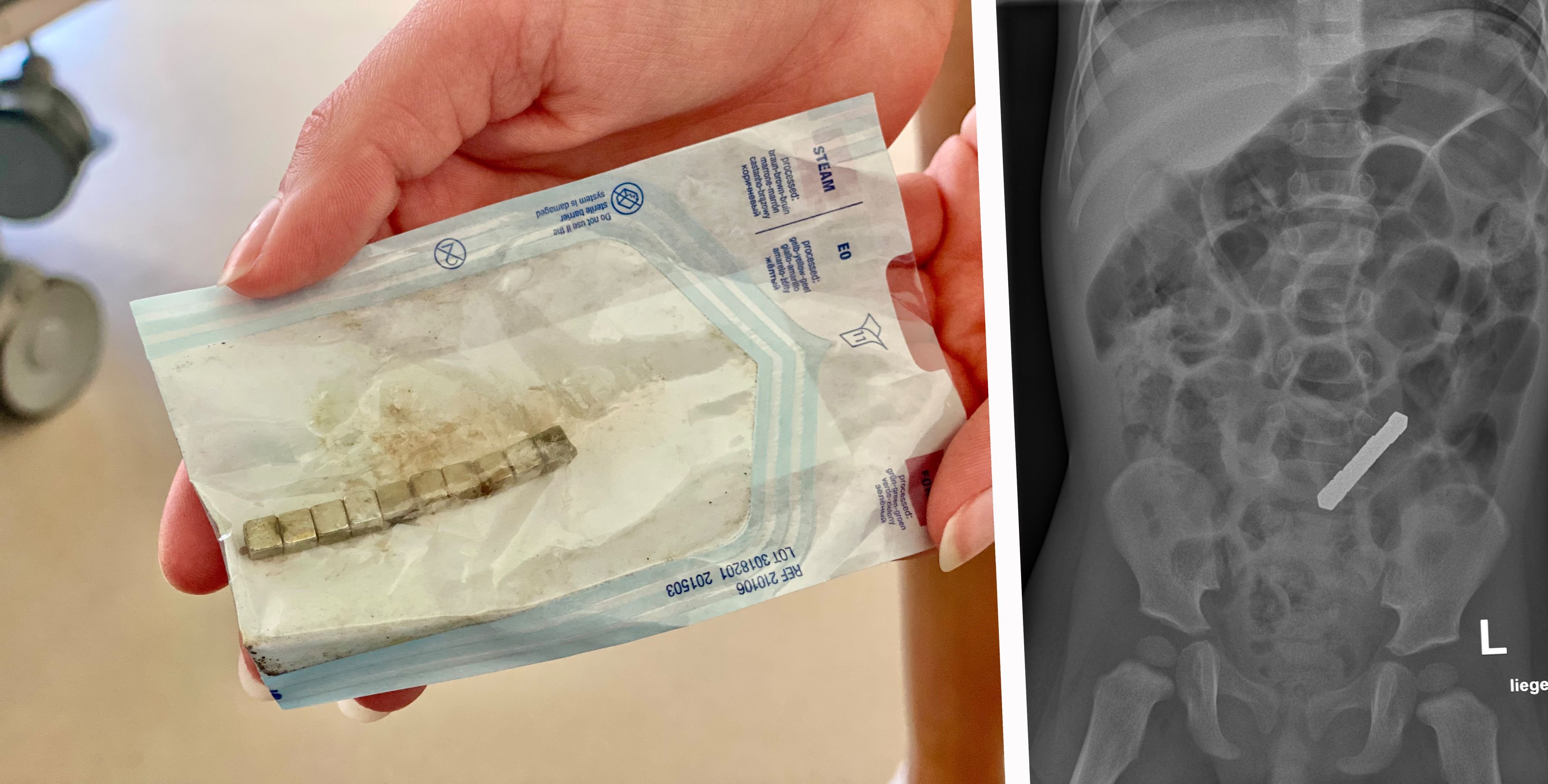 Diese Würfel hätten Alparslan (1) fast getötet! Links: die entfernten Magnete, rechts das Röntgenbild mit dem gefährlichen Fremdkörper im Bauch.