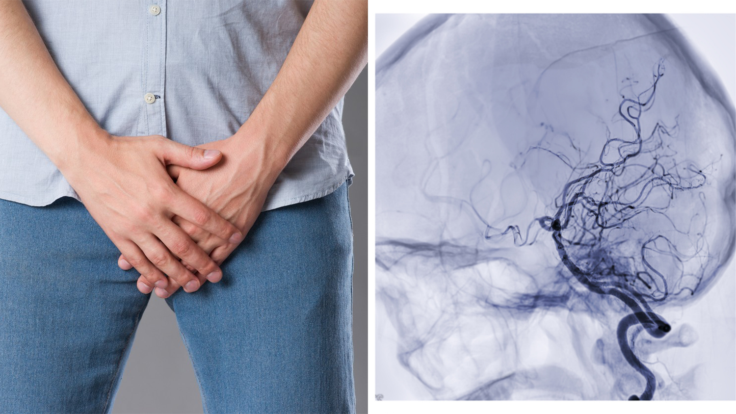 Der Mann erlitt eine Subarachnoidalblutung infolge eines Hirnaneurysma. (Symbolbild).