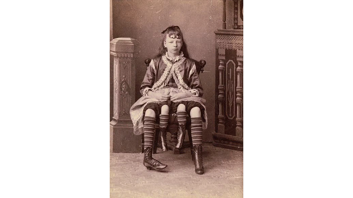 Myrtle Corbin, das «vierbeinige Mädchen», wurde in der zweiten Hälfte des 19. Jahrhunderts in den USA zu einer Berühmtheit. Sie hatte nicht nur vier Beine, sie verfügte auch über zwei vollständig ausgebildete Unterkörper.