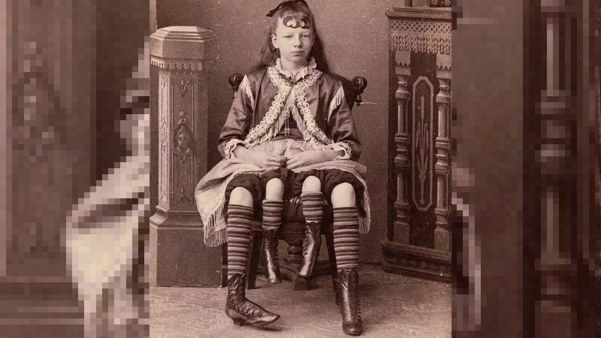 Heute.at - Sie wurde als das vierbeinige Mädchen berühmt