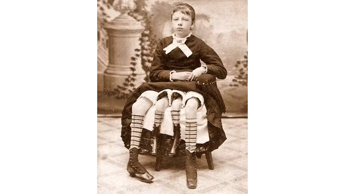 Myrtle Corbin wurde schnell zur Sensation.