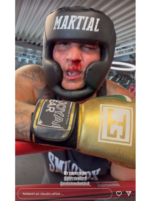 Pietro Lombardi zeigt sich in seiner Instagram-Story, wie er zugerichtet wurde.