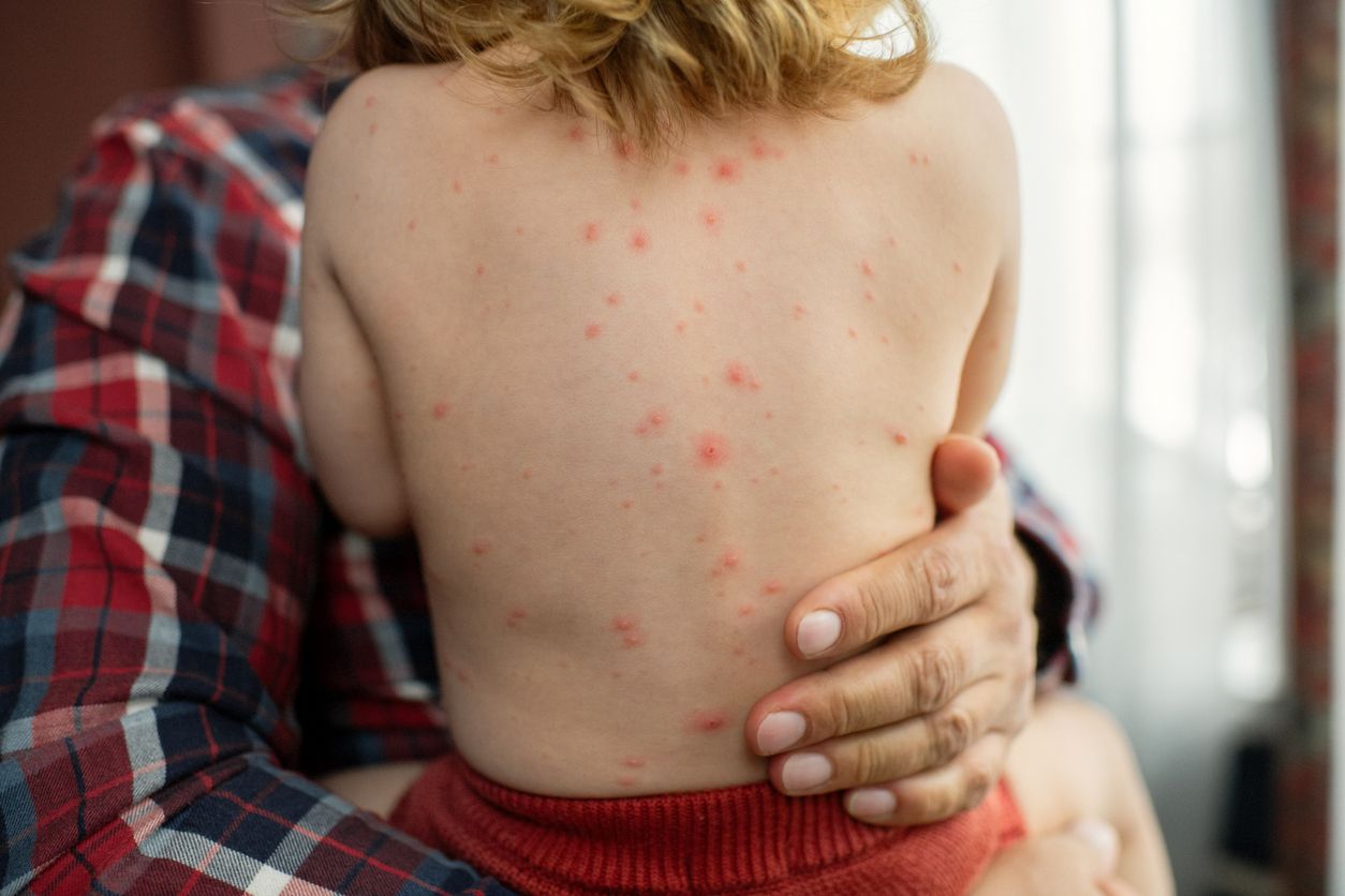 Der Badespaß kann mit gerötetem Hautausschlag mit zahlreichen Pusteln und kleinen Blasen enden.