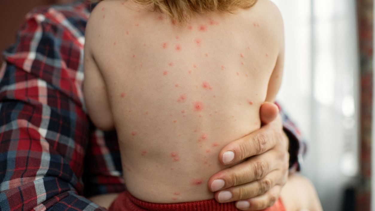 Der Badespaß kann mit gerötetem Hautausschlag mit zahlreichen Pusteln und kleinen Blasen enden.