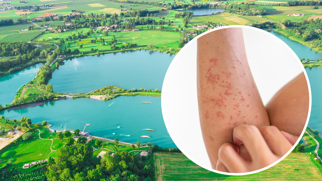 Auch in den Feldkirchner Badeseen kam es vergangenes Jahr schon zu Fällen von Zerkariendermatitis. (Symbolbild)