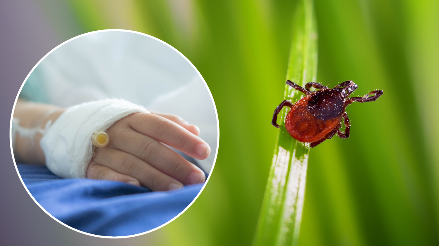 OÖ ist einer der absoluten Zecken-Hotspots. Für Kinder hatten die Stiche jetzt böse Folgen. (Symbolbild)