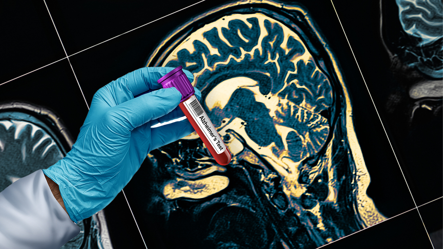 Heute.at - Alzheimer – Neuer Bluttest vereinfacht Diagnose