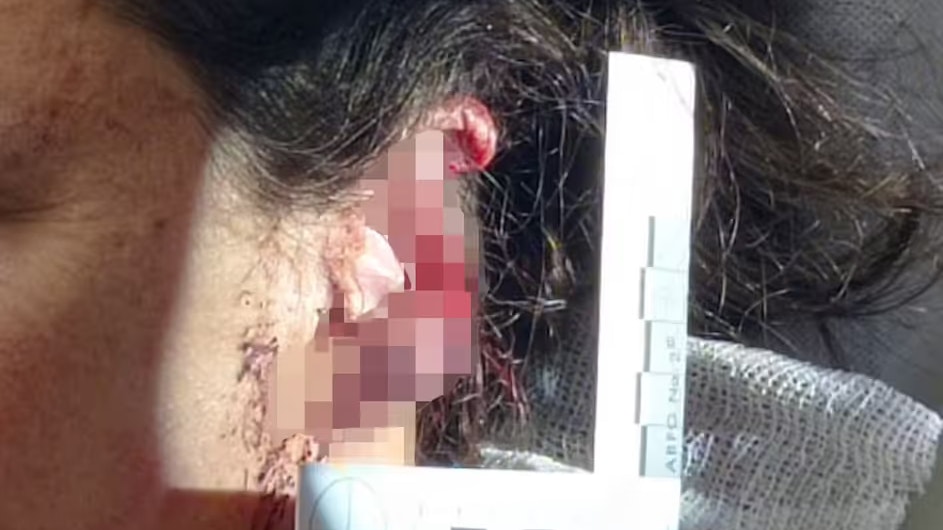 Heute.at - Pitbull beißt Frau Drittel vom Ohr ab – Halter flüchtet