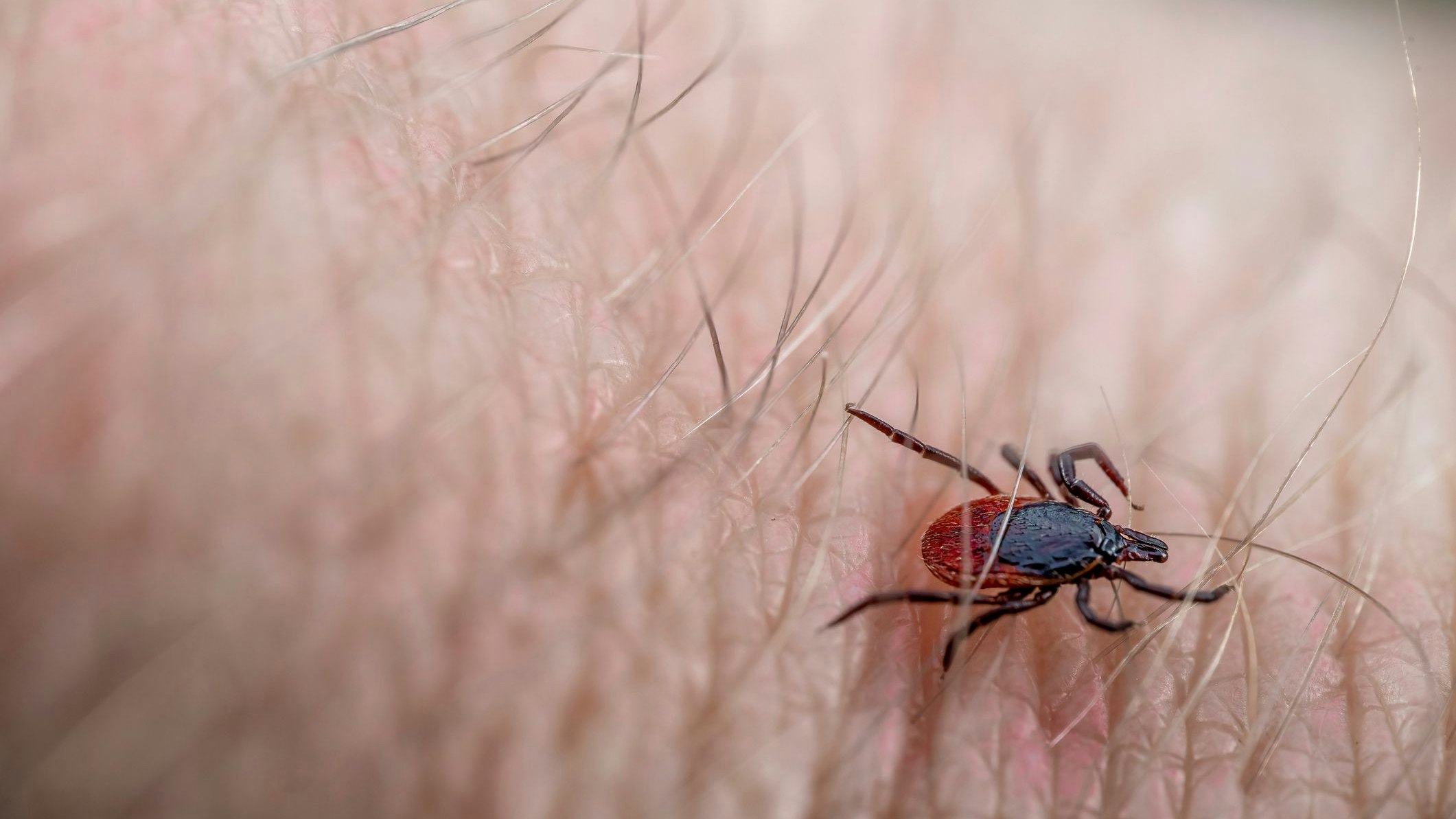 Ein harmloser Zeckenbiss entwickelte sich für einen Manager zum Albtraum.