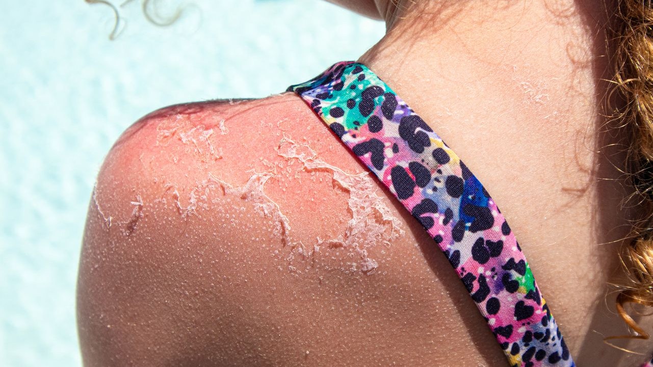 Heute.at - Hausmittel gegen Sonnenbrand – was wirklich hilft