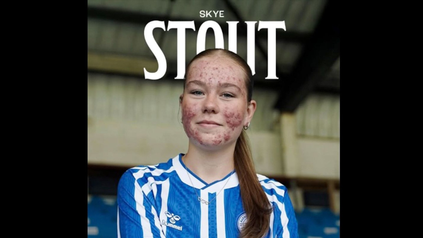 Heute.at - Hass wegen Akne – jetzt warnt Psychologin vor Folgen