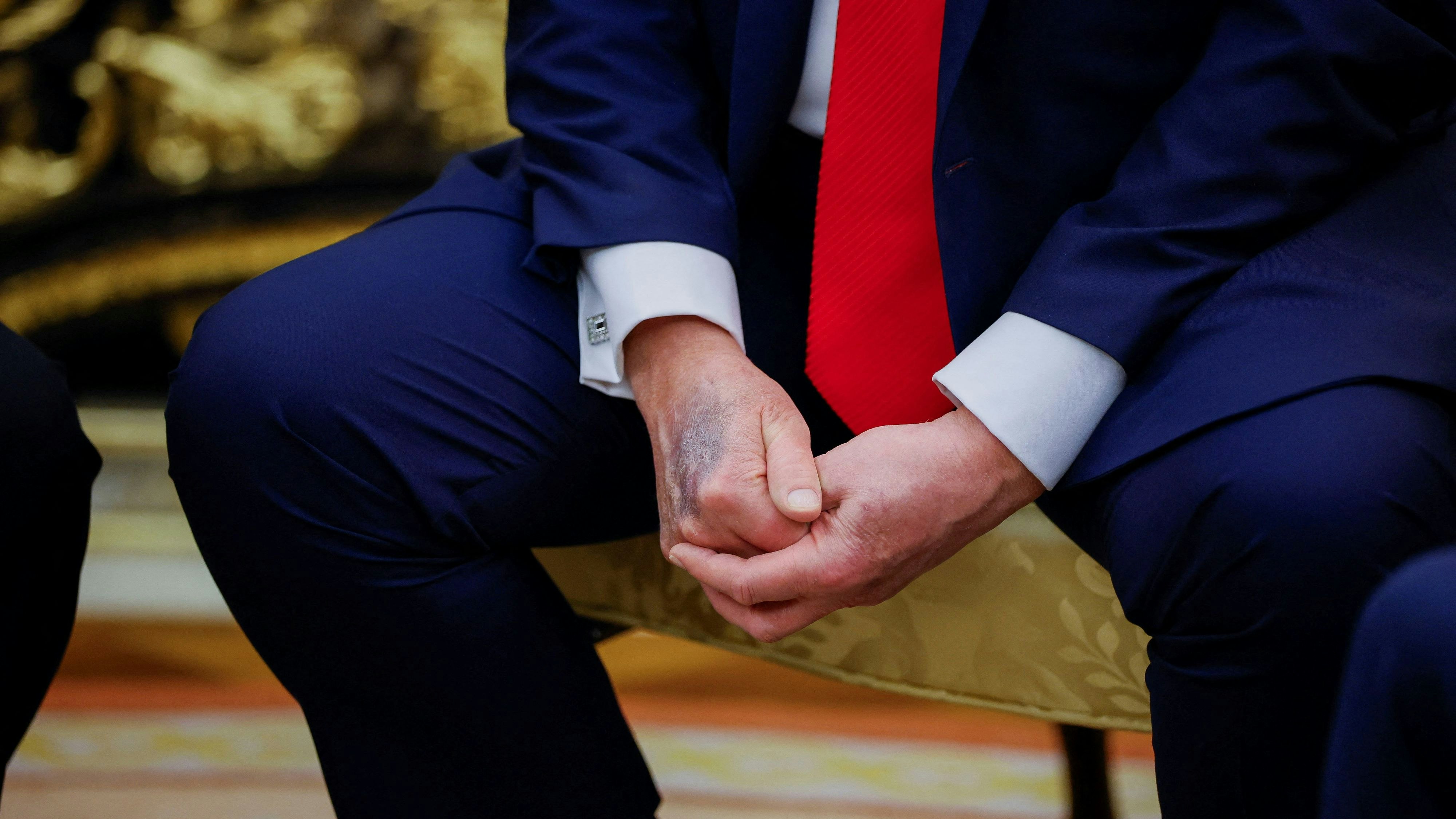 Heute.at - Wieder rätselhafter Fleck an Trumps Hand aufgetaucht