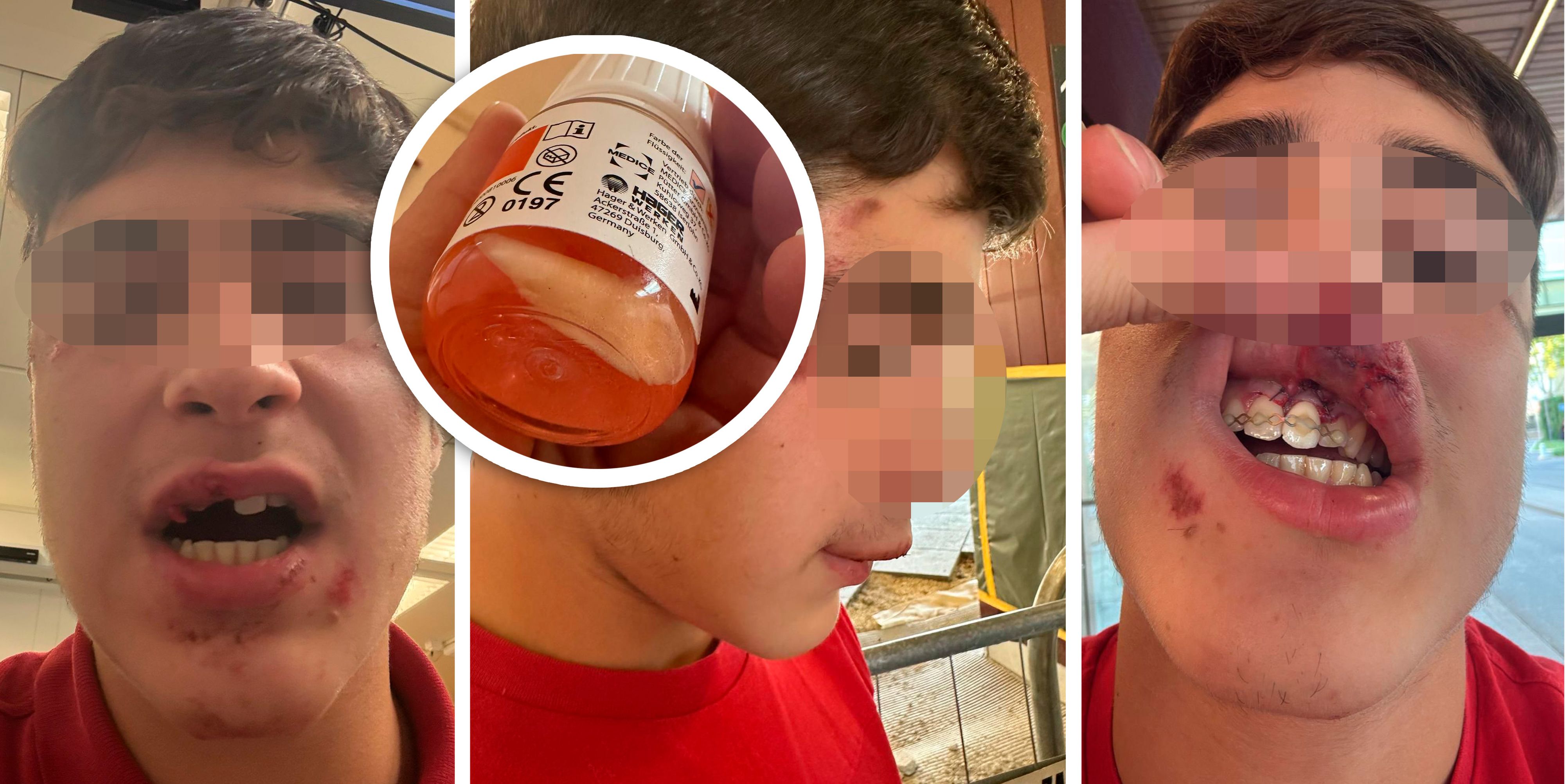 Dem 15-Jährigen wurde im Park in Wien-Leopoldstadt der Schneidezahn ausgeschlagen.