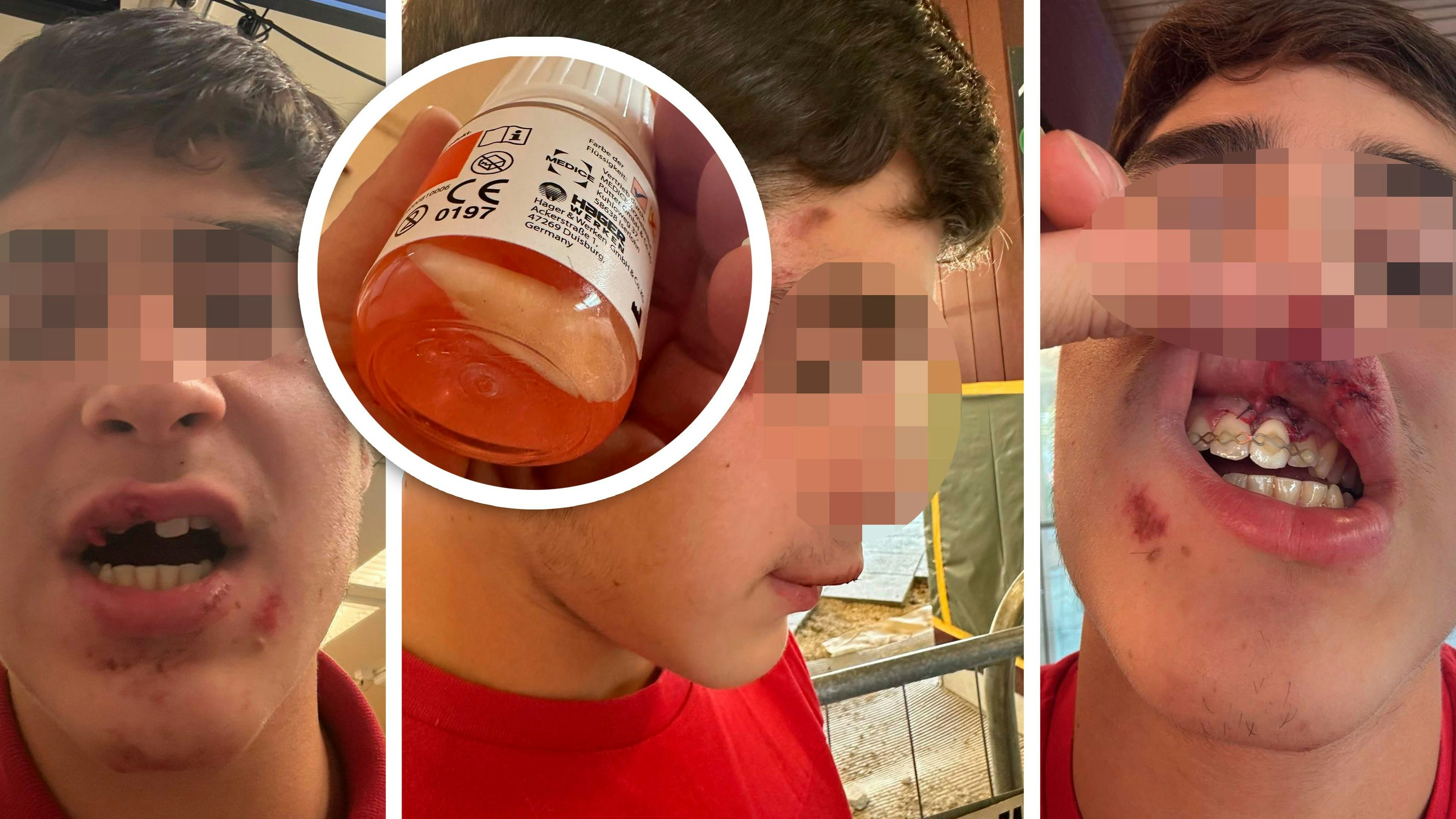 Dem 15-Jährigen wurde im Park in Wien-Leopoldstadt der Schneidezahn ausgeschlagen.