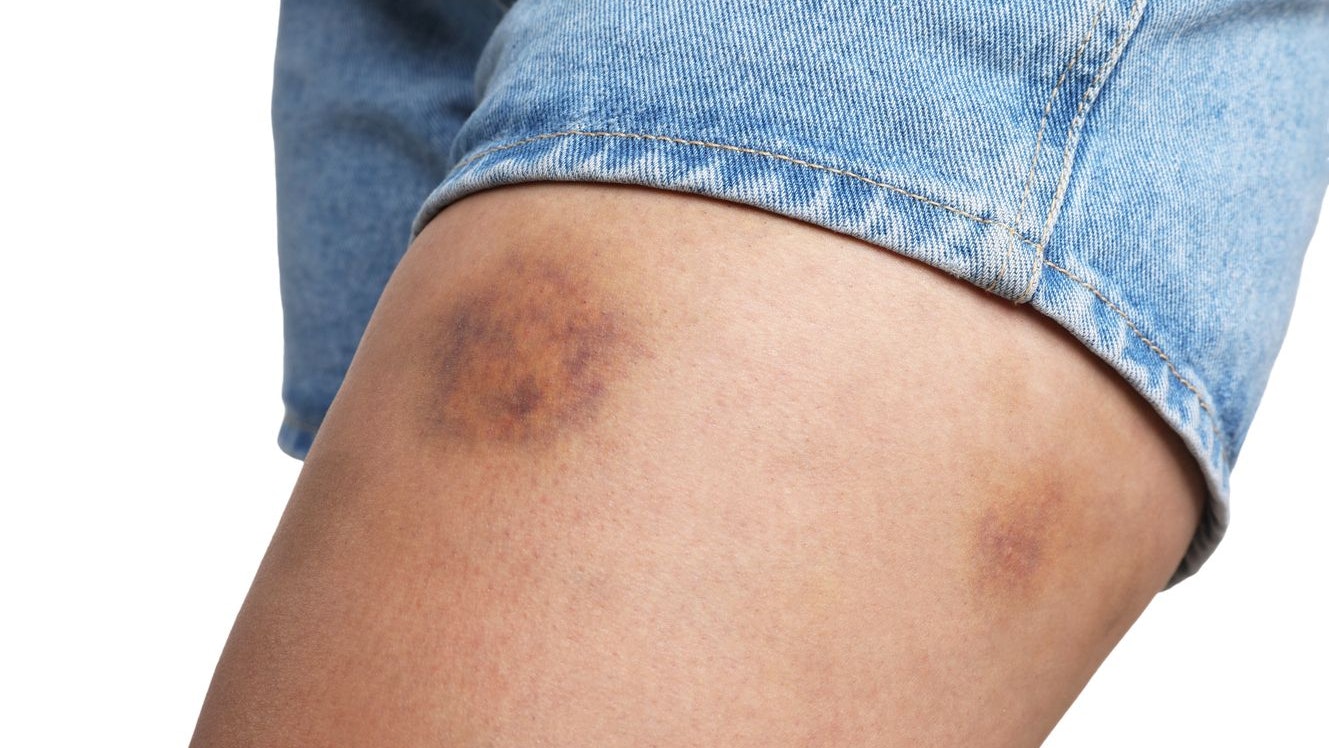 Woman with bruise on leg against white background, closeup