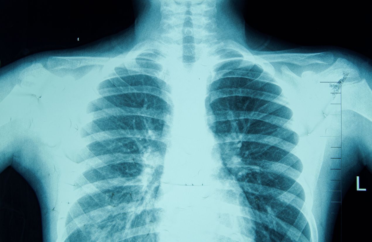 Lungenkrebs wird meist erst in einem schwer behandelbaren Spätstadium entdeckt.