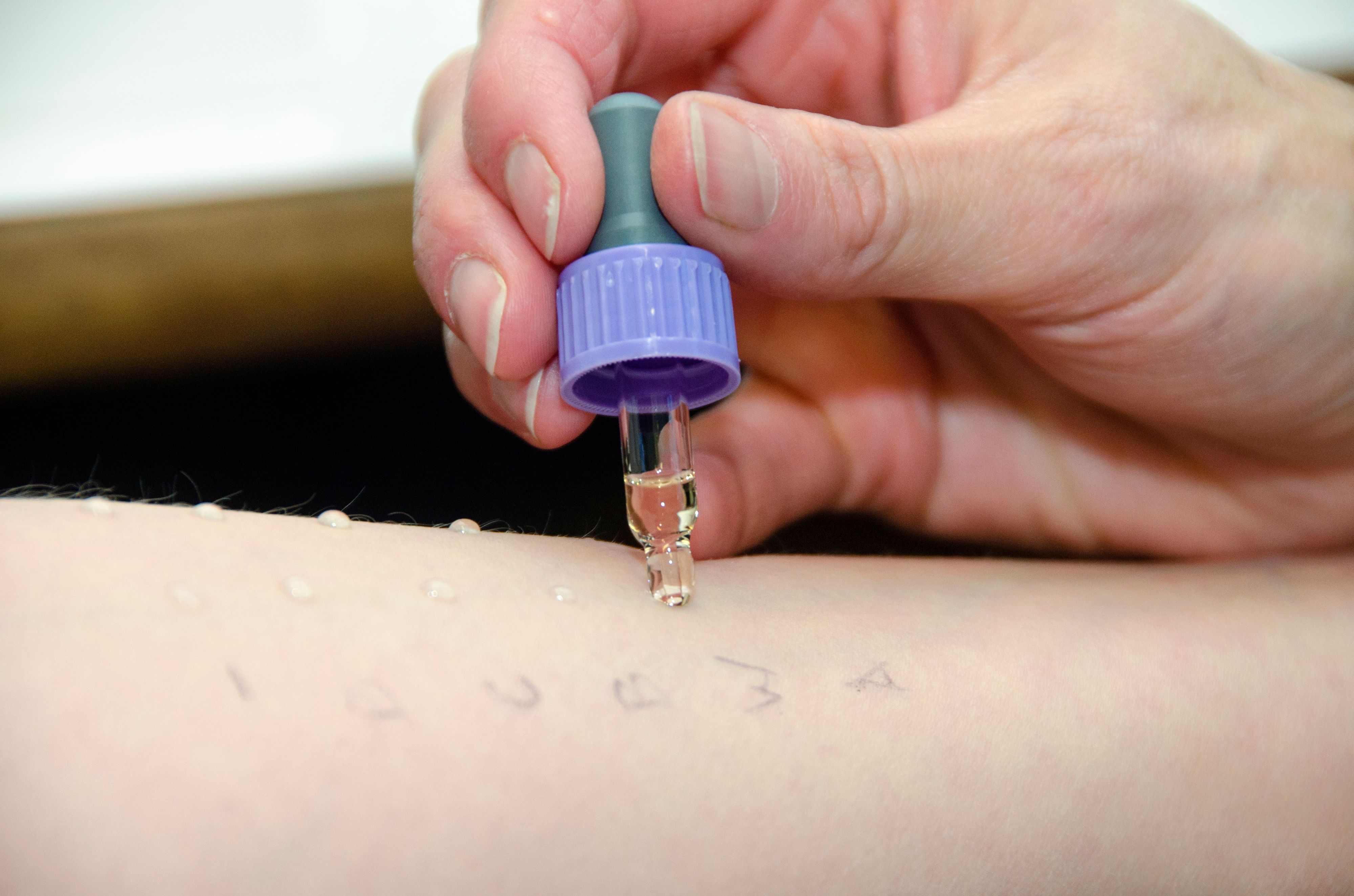 Der Prick-Test (Bild) ist einer der bekanntesten Allergietests.