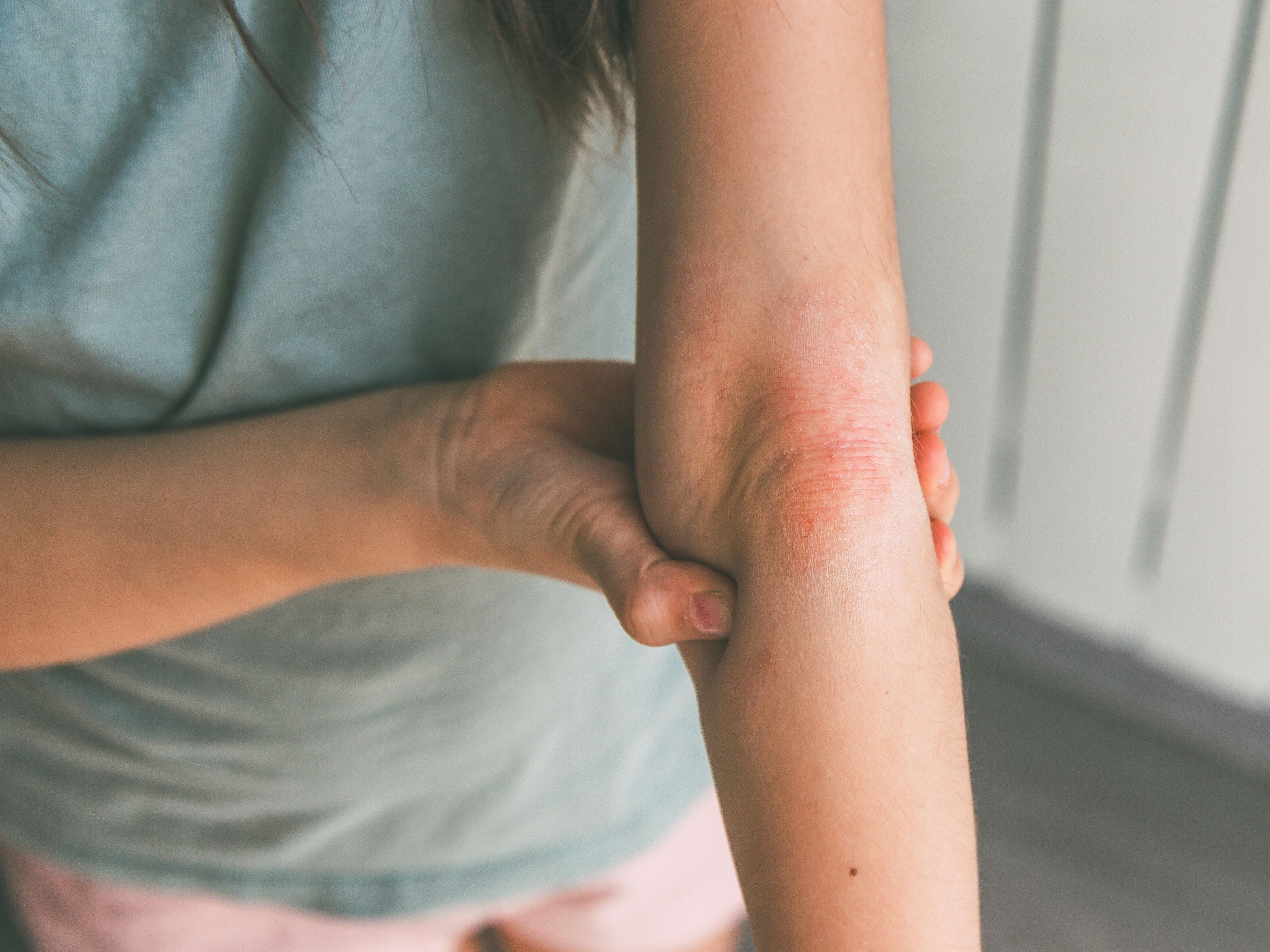 Die Neurodermitis verläuft schubförmig. Es wechseln sich Phasen fast völliger Beschwerdefreiheit mit symptomatischen Phasen ab.